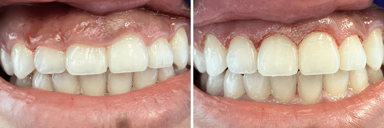 Gummy Smile & Gum Contouring Recovery - How Long? Will it Hurt?
